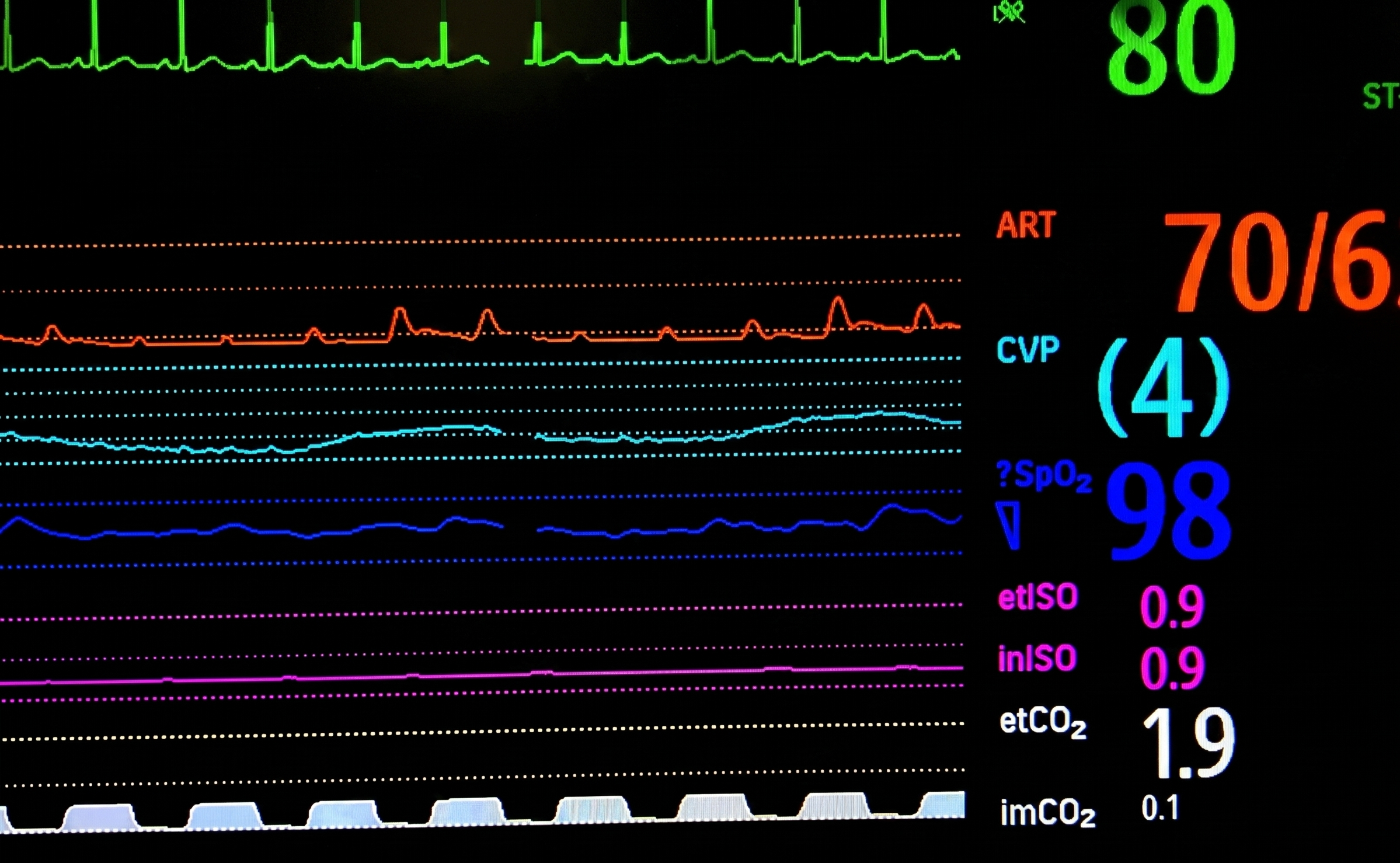 Philips IntelliVue monitor at baseline showing narrow PP and PPV