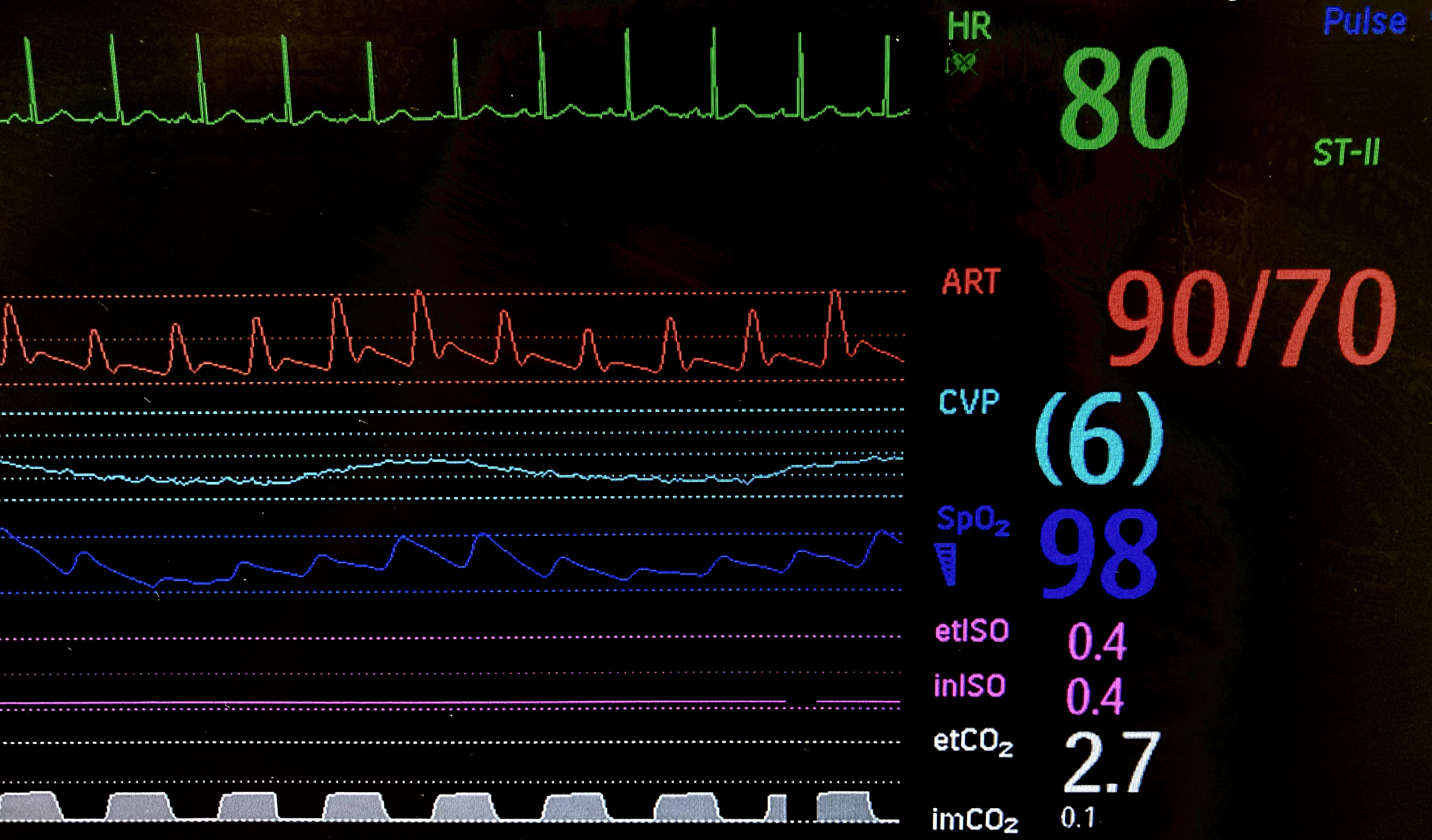Philips IntelliVue monitor post-fluid challenge