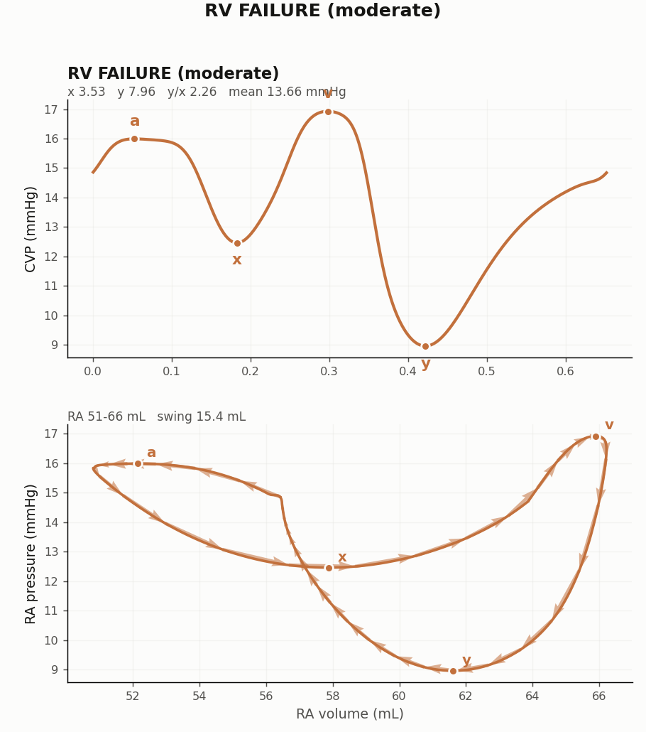 Right atrial pressure volume loop reconstruction and CVP morphology